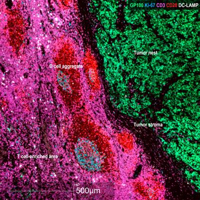 HEV-associated dendritic cells are observed in metastatic tumor-draining lymph nodes of cutaneous melanoma patients with longer distant metastasis-free survival after adjuvant immunotherapy